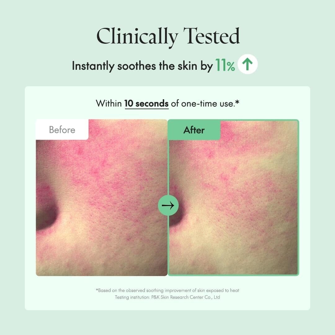 Routine for Mild or Severe Acne Breakouts